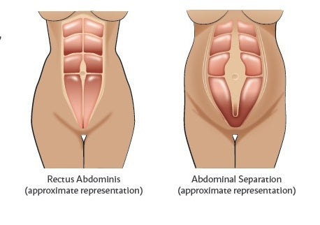Illustration of abdominal separation