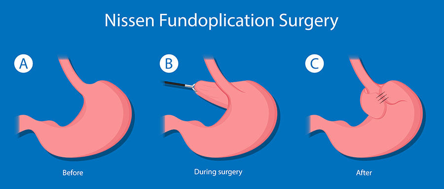 Illustration shows the state of stomach before, during, and after Nissen Fundoplication Surgery 