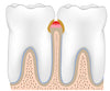 Water flosser treatment for gingivitis