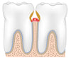 water flosser periodontitis