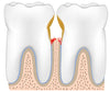 water flosser Periodontal Disease