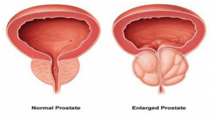 reflexology aids an enlarged prostate 