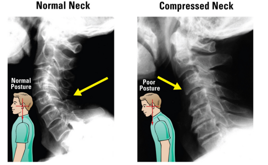 Normal Neck and Compressed Neck