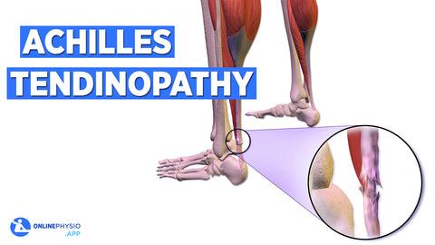 What is an Achilles Tendinopathy? How do you treat it?