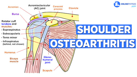 Shoulder Osteoarthritis