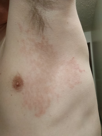 Keto Rash Day 1