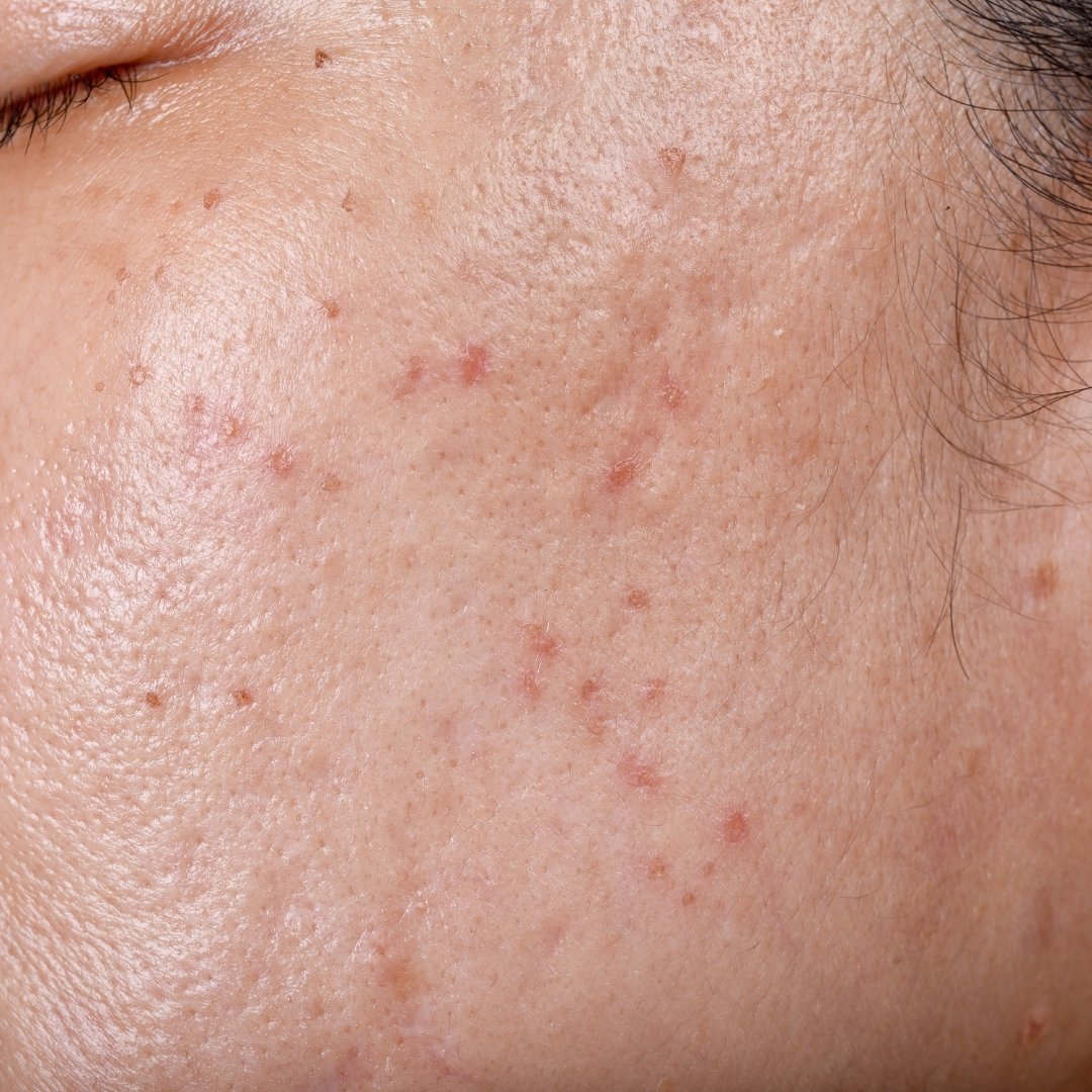 acne-treatment-for-adults-what-causes-acne-in-adults-and-how-to-treat