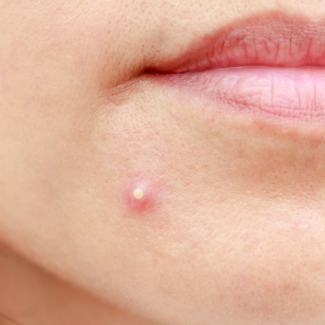 pimples-with-white-heads-why-do-i-get-them-and-how-do-i-get-rid-of