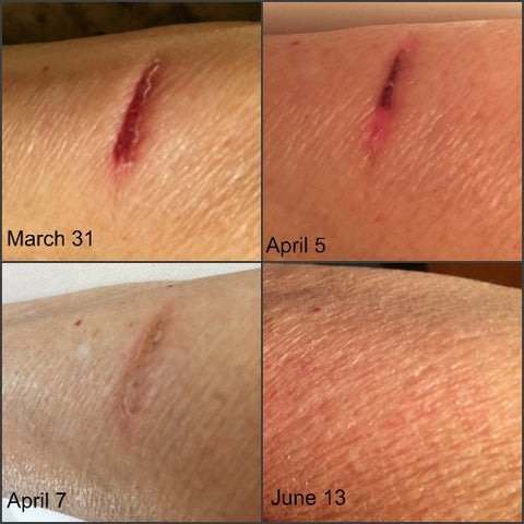 Time lapse photos of burn scar healing with emu oil