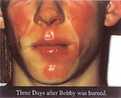 Boy with severe burns on face