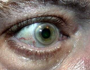 Scleral Argyria