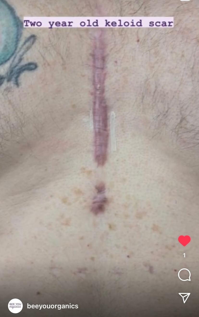 microdiscectomy scar