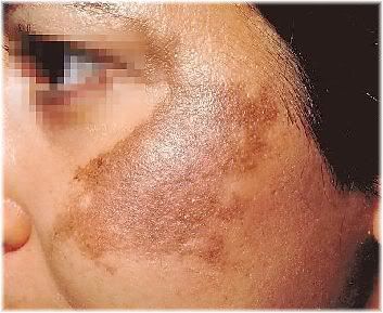 hyperpigmentation