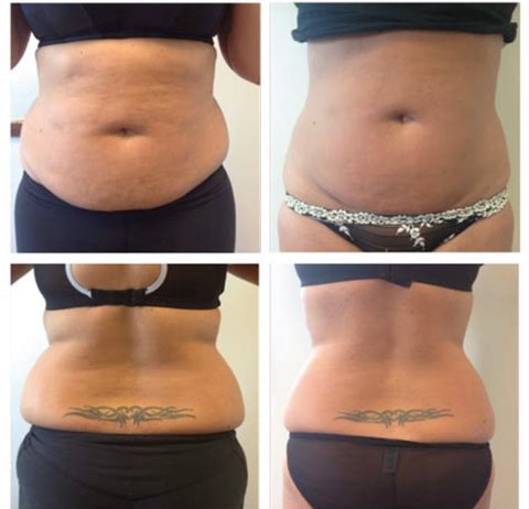 3d liposuction leeds