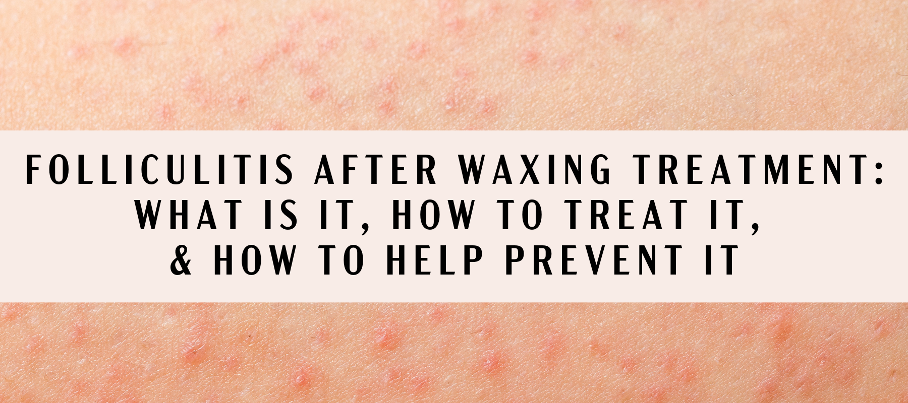 Spille computerspil hele deres Folliculitis After Waxing Treatment: What Is It, How To Treat It, How –  Honeycomb Wax Co.