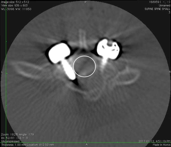 Caudal Articular Process Dysplasis - Plate placement CT scan