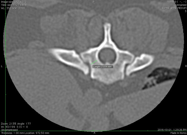 CT Scan of Lily's T11 corridor - uncompressed