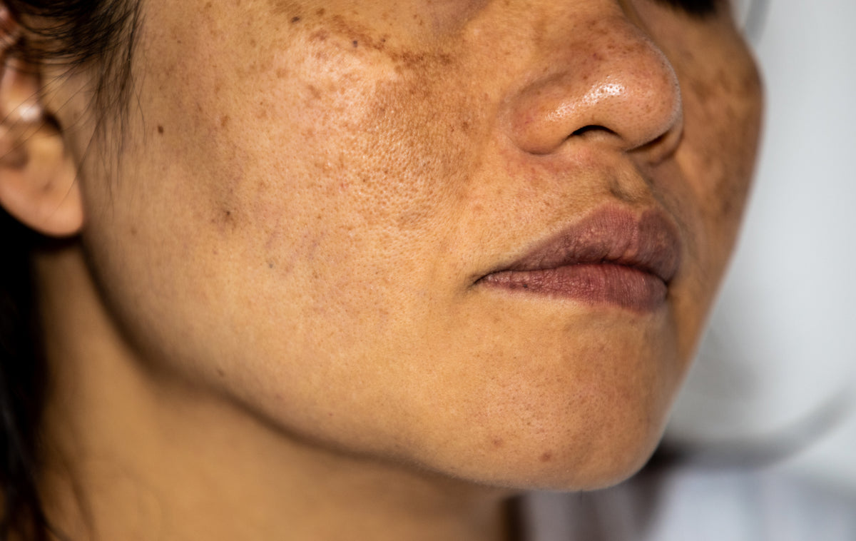 Defining Hyperpigmentation—Your Guide to Understanding Skin Discolorat – Rx RAGA, LLC