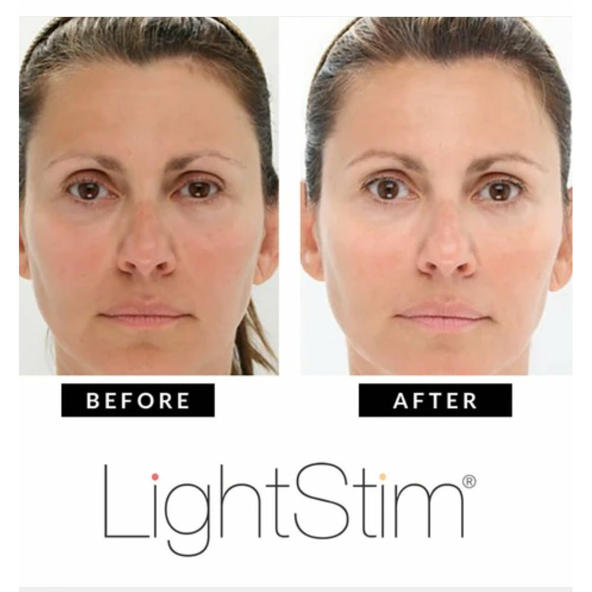 lightstim anti aging kezelés)