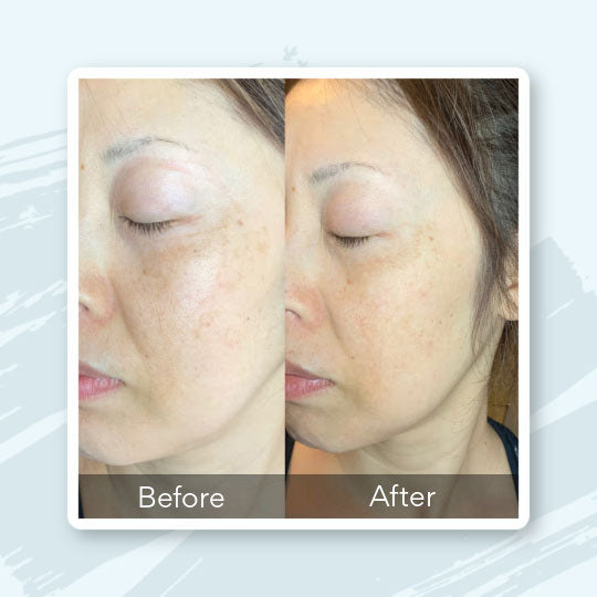 Book a Glycolic Peel Medical Spa Treatment in Knoxville, TN