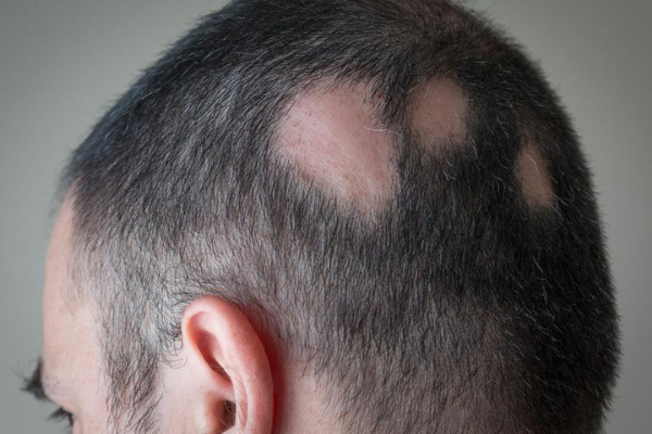 What Causes Hair Loss In Patches On The Head 