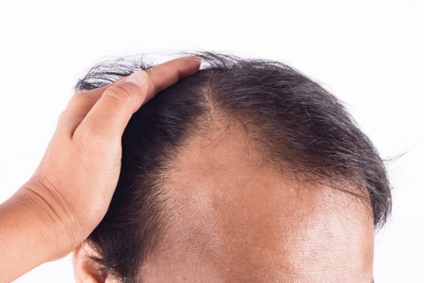 Oily Scalp: How to Manage and Get Rid of It?