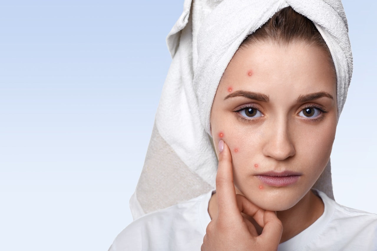 How Do You Get Rid Of Blood-Filled Pimples?