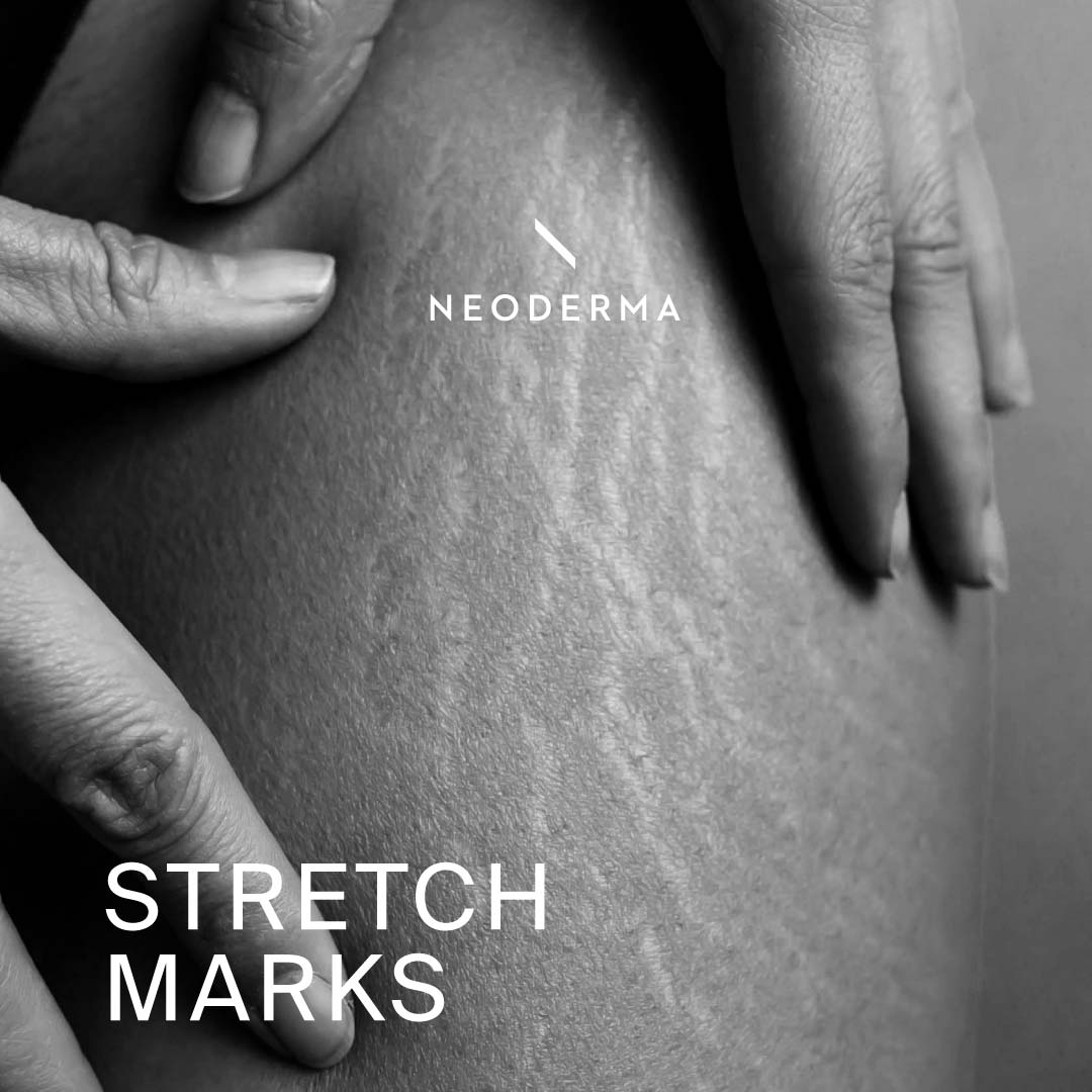 Skincare Stretch Marks Neoderma 4275