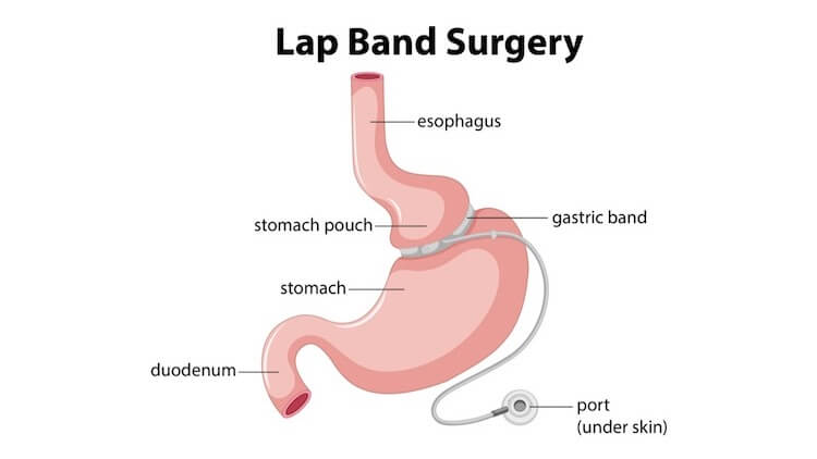 Lap Band Surgery Cost Risk And Diet Before And After The Procedure Phenq Usa