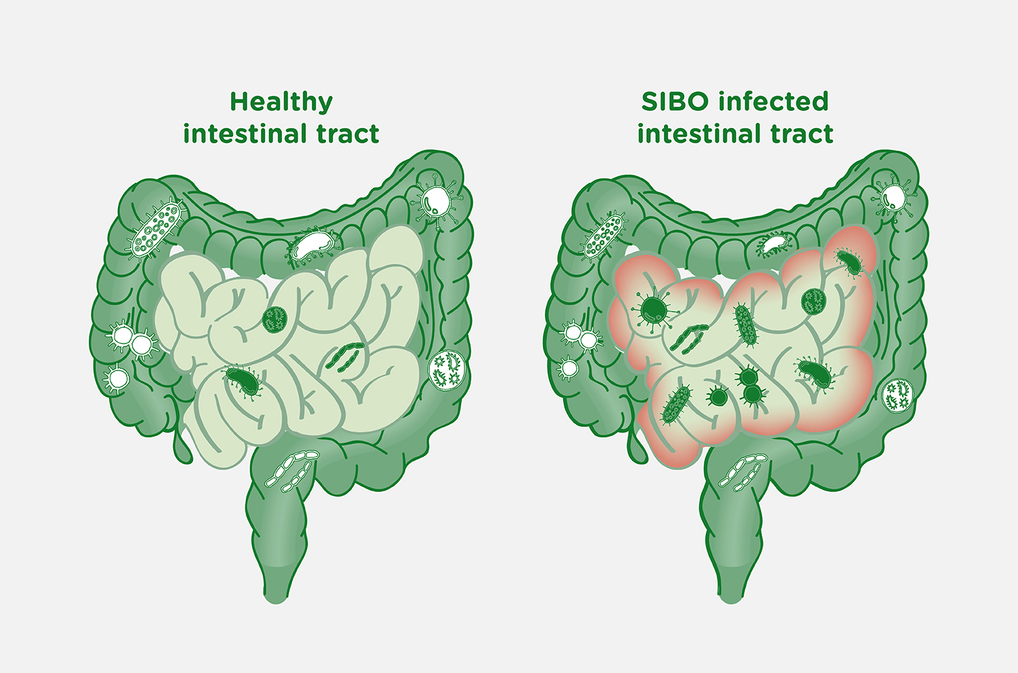 SIBO: How Small Intestinal Bacterial Overgrowth Impacts the Microbiome – Bio-K+