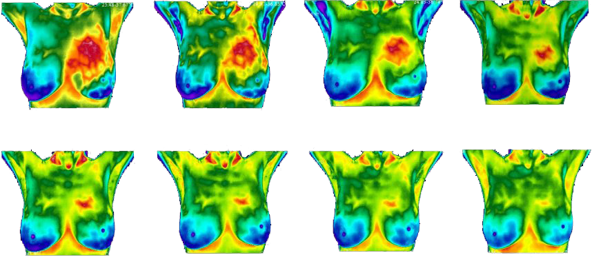 Breast Thermography