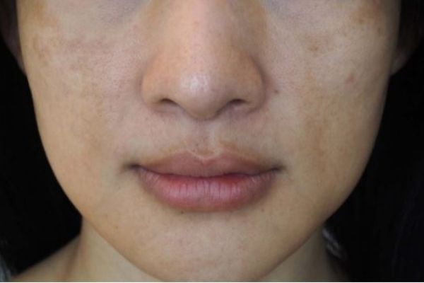 Does Glycolic Acid Help With Hyperpigmentation?