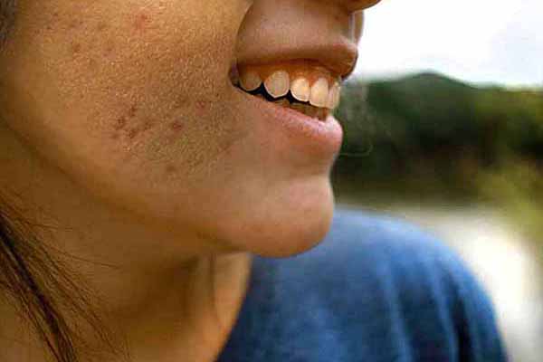 Get Rid Of Acne Scars: The 5 Best Ways to Heal Your Skin