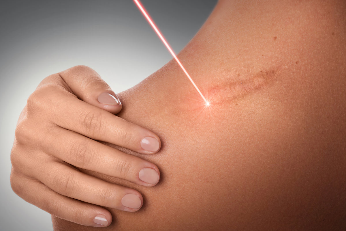 laser vaginal rejuvenation