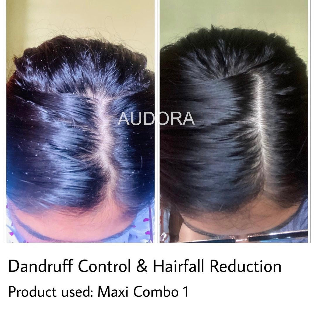 COMBO 1 Hair Fall Control | Re-Growth – 