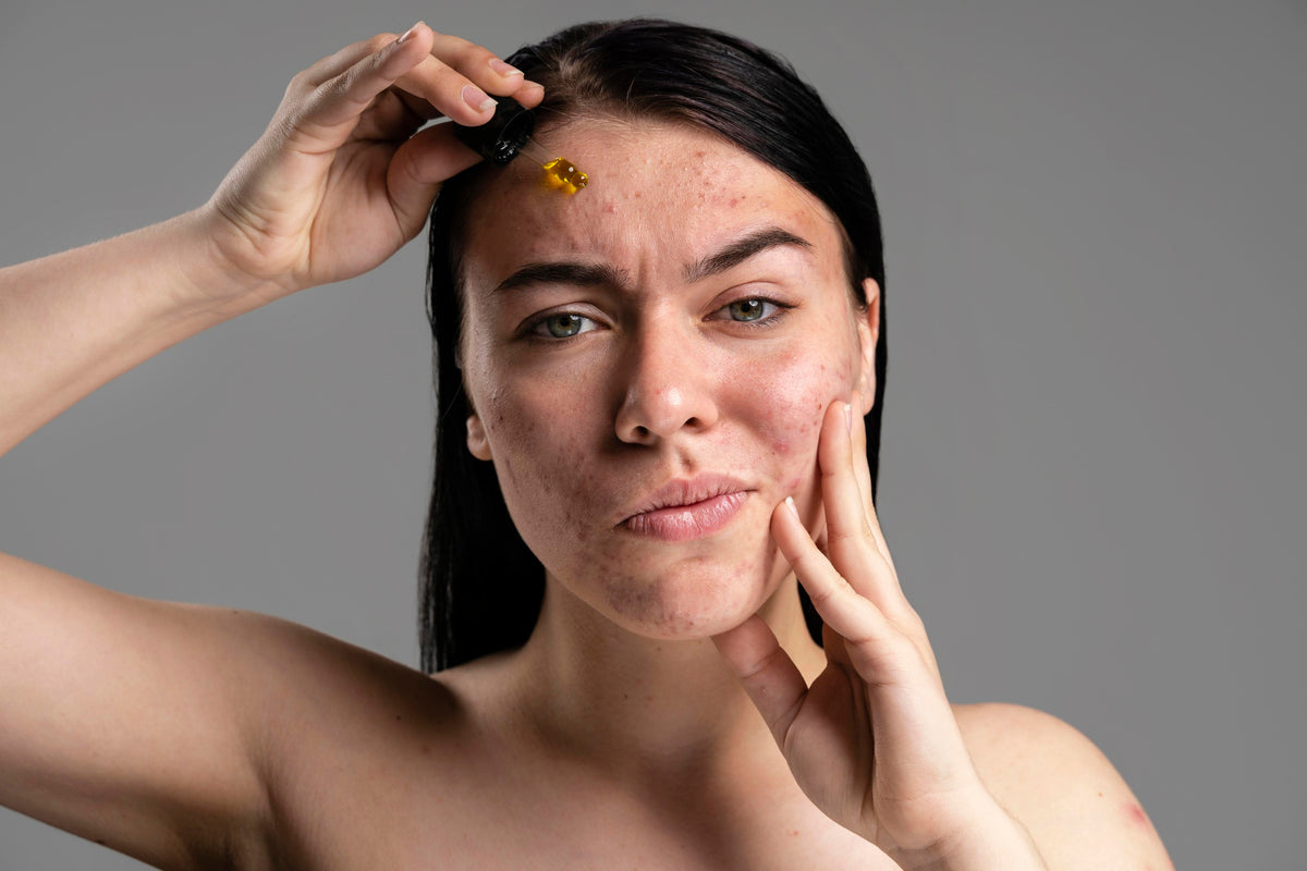 Is Your Acne Hormonal Or Bacterial A Comprehensive Guide To Identifyi