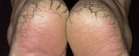 Cracked heels for Sweet Potato Lotion