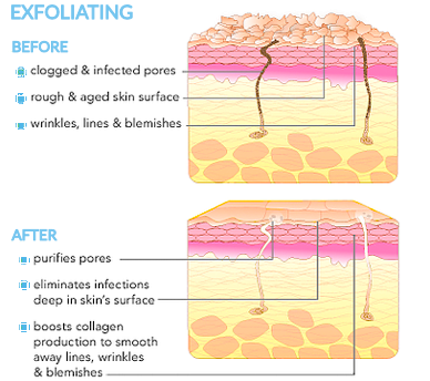 diagram-of-exfoliation-on-skin-before-and-after-www.rdalchmy.com