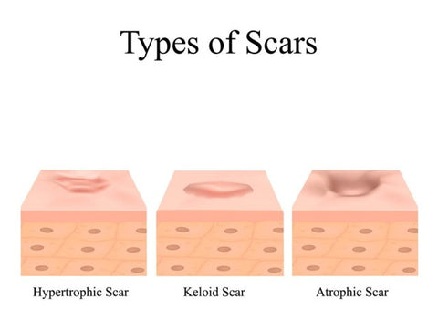 diagram-showing-different-types-of-acne-scars-www.rdalchemy.com