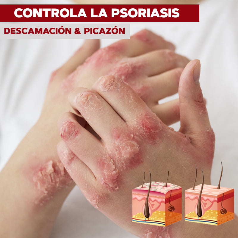 SPRAY CONTRA LA PSORIASIS - NOTPSORIASIS™