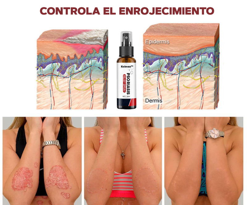 SPRAY CONTRA LA PSORIASIS - NOTPSORIASIS™