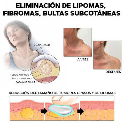 CREMA ELIMINADORA DE LIPOMAS - LIPOMFREE™