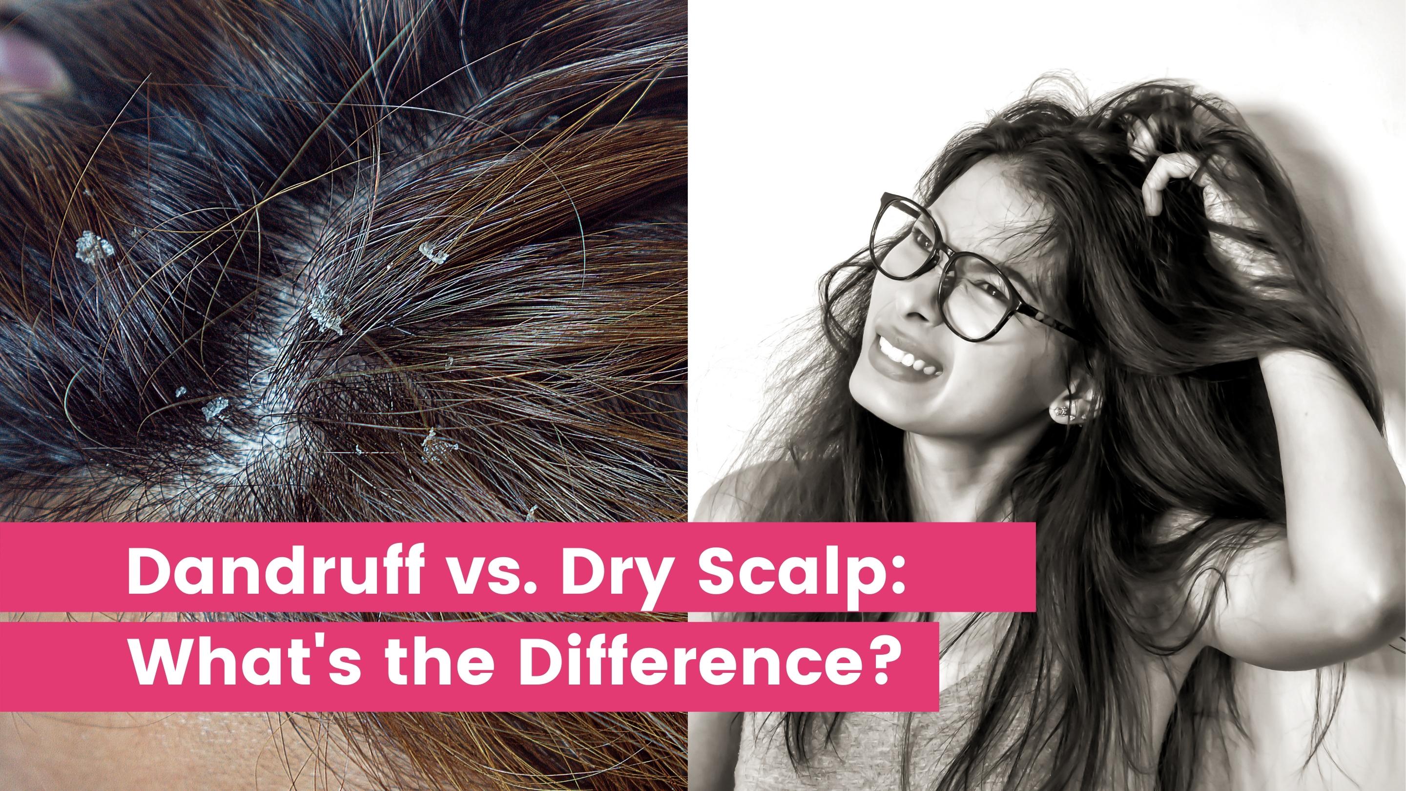Dandruff vs. Dry Scalp