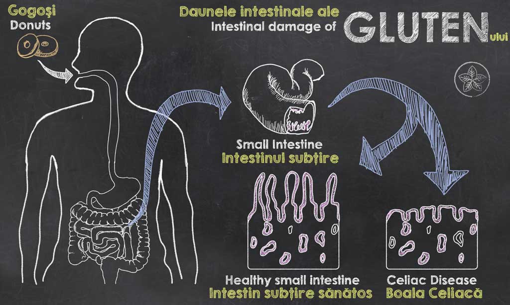 intoleranta la gluten - boala celica