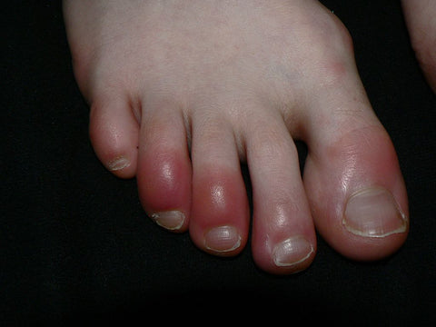 How to prevent chilblains this winter