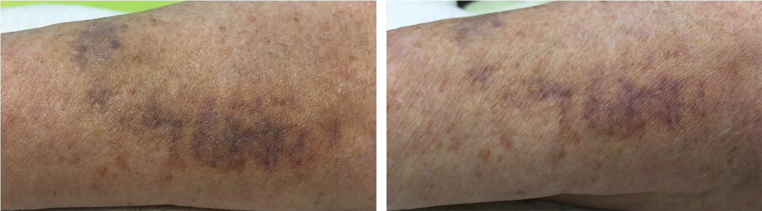 Wound Healing Before/After