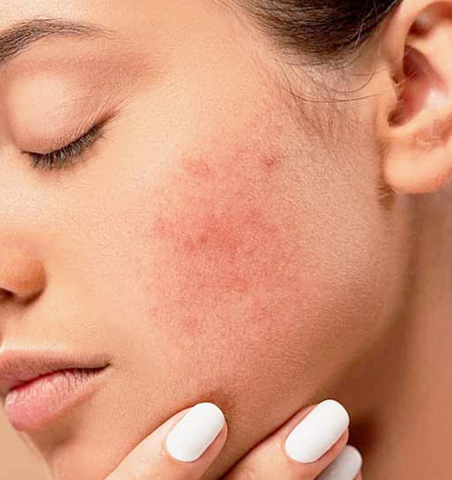 Acne Trouble? 3 Ways of Removing Dead Skin From Your Face – beautybybie