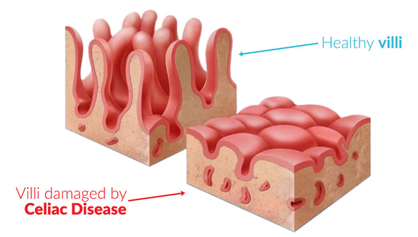 Undamaged vs damaged villi.  Gluten levels the villi.