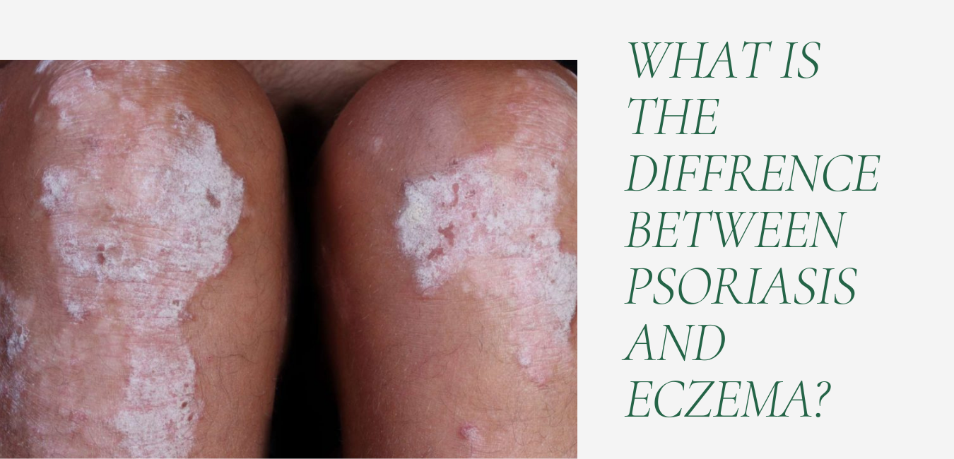 Whats The Difference Between Psoriasis And Eczema