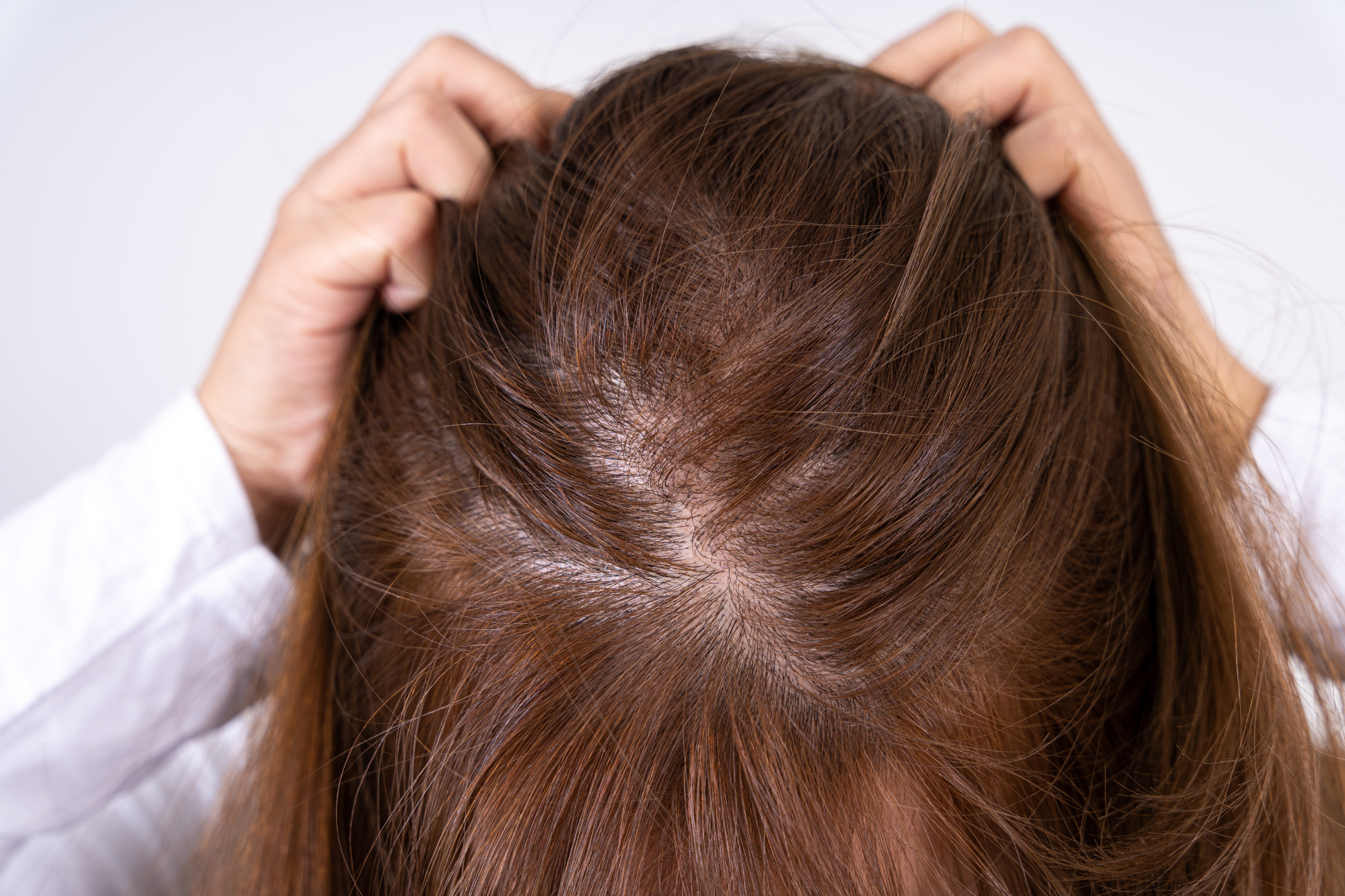 vest indkomst Tredive First Signs of Hair Thinning – Revela